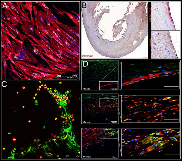 Uptake-of-cholesterol-crystals